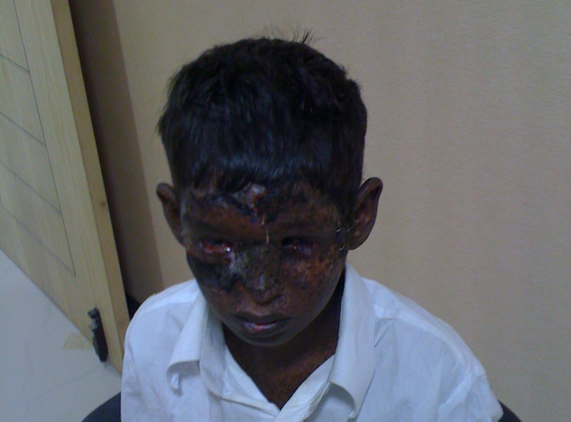 Bhargav After Operation 1
