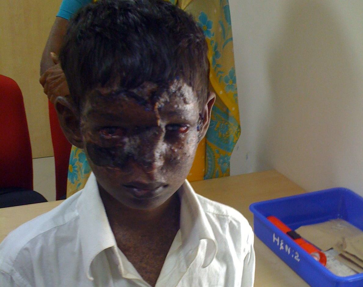Bhargav After Operation 3